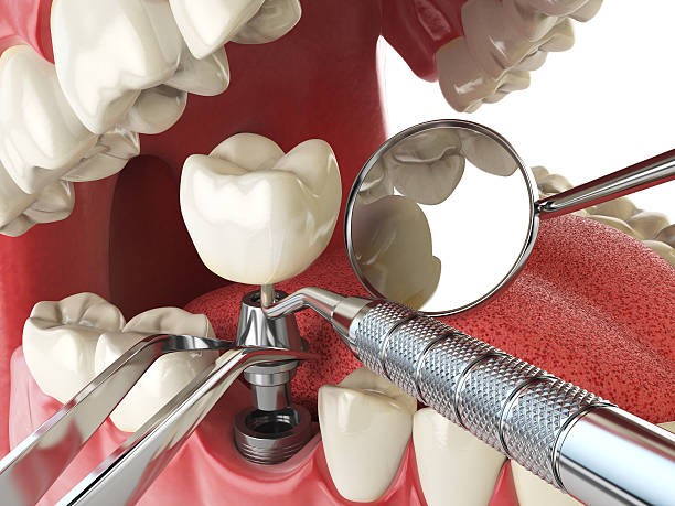 Best Emergency Dental Extractions in Henderson, GA